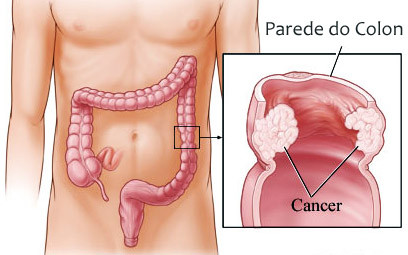 Câncer de intestino e colorretal