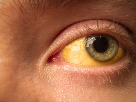 Icterícia Olhos amarelados