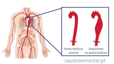 aneurisma da aorta ascendente torácica