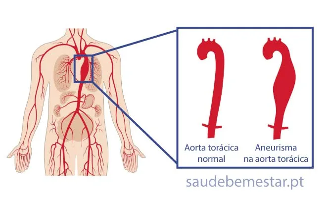 aneurisma da aorta ascendente torácica